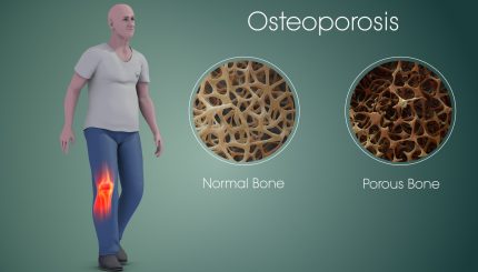 Male-and-female-Osteoporosis