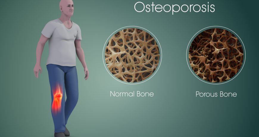 Male-and-female-Osteoporosis