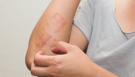 What_s-Usually-The-First-Sign-Of-Dermatitis