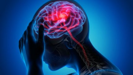 brain-stroke-photo-3d