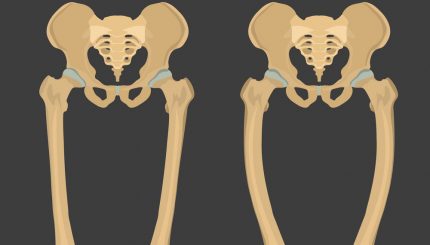children-normal-bone-compare-with-rickets-bone