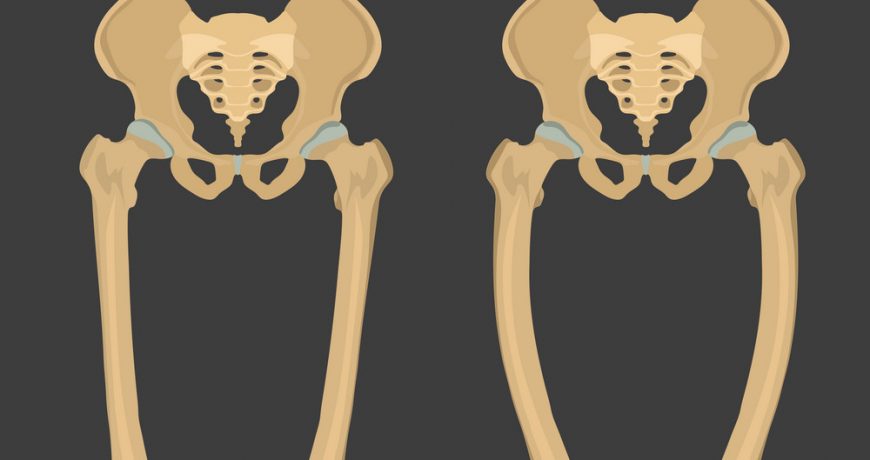 children-normal-bone-compare-with-rickets-bone