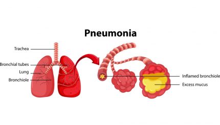 diagram-showing-lung-with-pneumonia