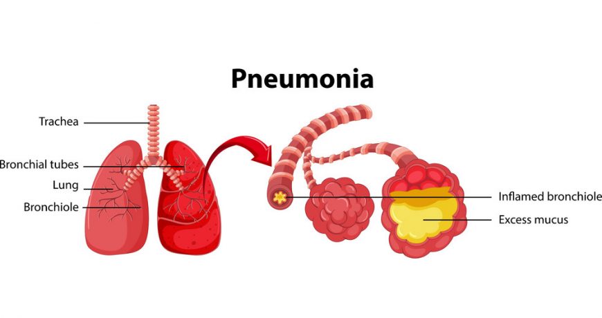 diagram-showing-lung-with-pneumonia