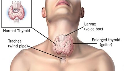 normal-thyroid-gland-vs-enlarged-thyroid-gland-or-goiter