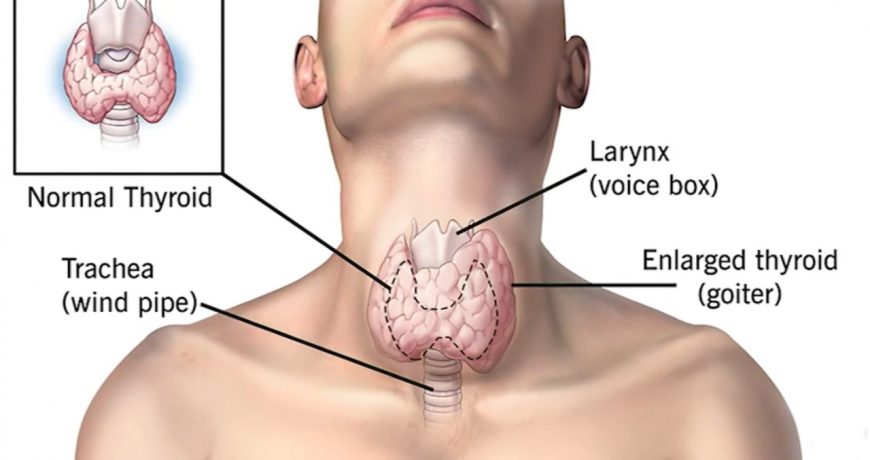 normal-thyroid-gland-vs-enlarged-thyroid-gland-or-goiter