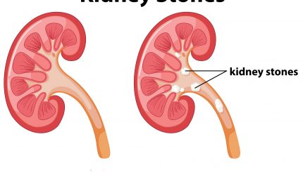 Kidney-stone-and-management