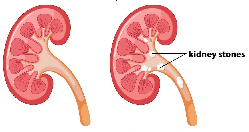 Kidney-stone-and-management