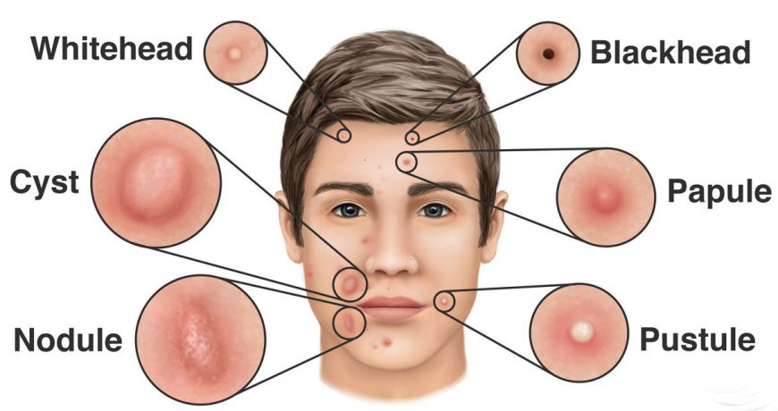 acne-and-dandruff-causes-treatment-and-management