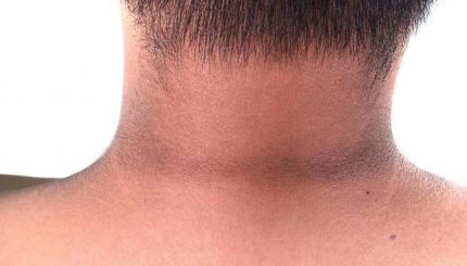 black-neck-remedy