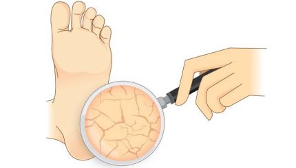 cracked-heal-causes-treatment-and-management-in-winter