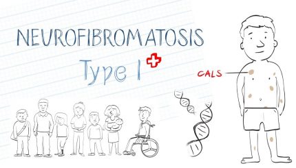 neurofibromatosis-disease-causes-treatment-and-management