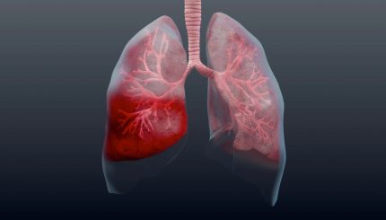 aspiration-pneumonia-management-and-treatment