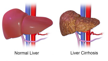 liver-cirrhosis-causes-treatment-and-management