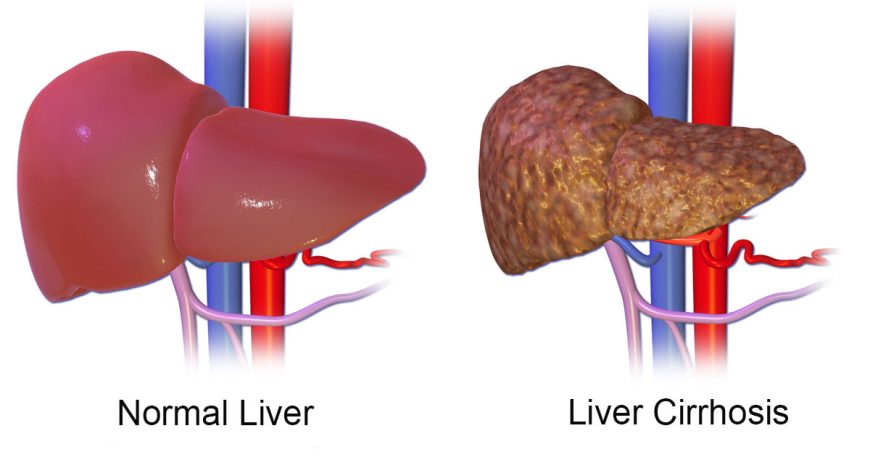 liver-cirrhosis-causes-treatment-and-management