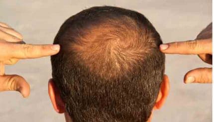 baldy-head-skull-skinn-disease