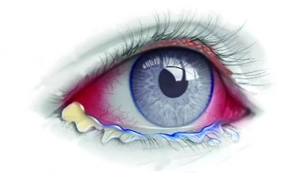 conjunctivitis-management-and-treatment