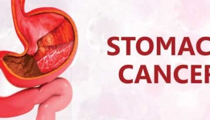 stomach-cancer-causes-treatment-and-management