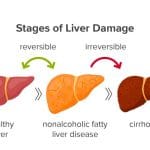 nonalcoholic-fatty-liver-disease