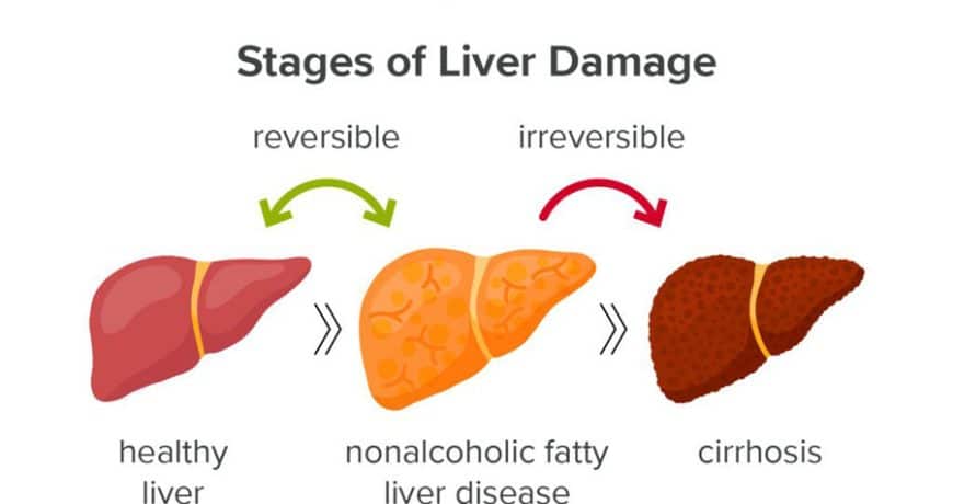 nonalcoholic-fatty-liver-disease